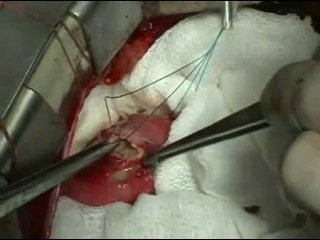 heart surgery. surgeons remove a colony of tapeworms